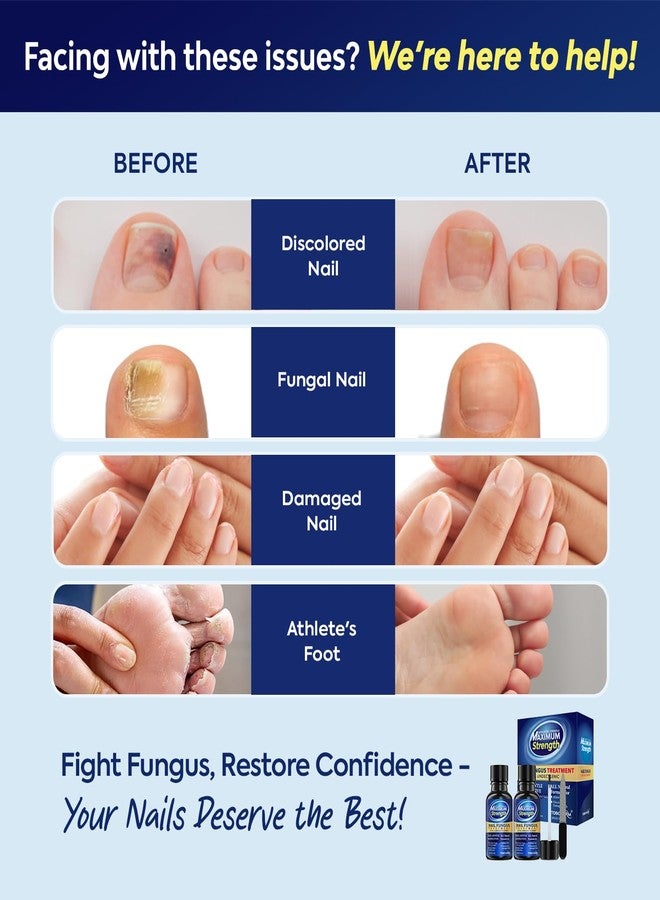 Tobcharm Toenail Fungus Treatment with 25% Undecylenic Acid, Toe Fungus Treatment for Toenail, Fungus Nail Treatment, Toenail Fungus Treatment Extra Strength, Fungal Nail Treatment for Athletes Foot - 2pcs - Image 3